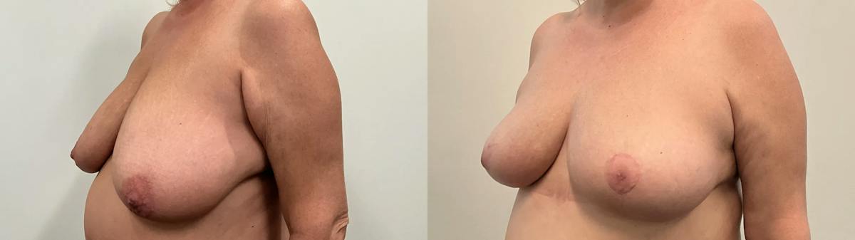 Breast Reduction Before & After Gallery - Patient 129334 - Image 4