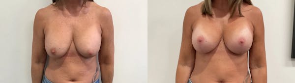 Breast Augmentation Revision Before & After Gallery - Patient 137972 - Image 1