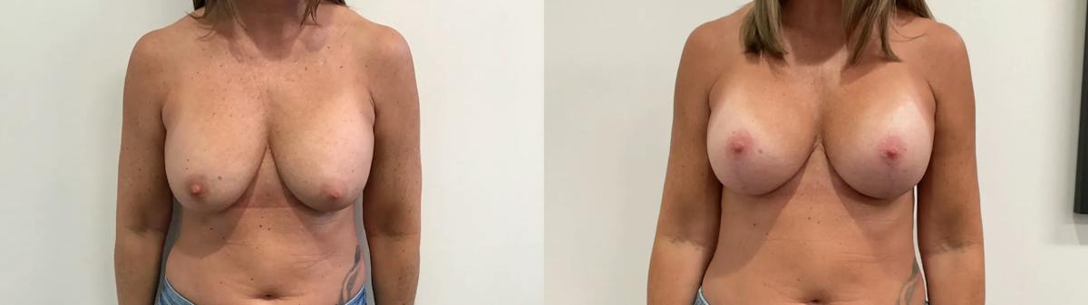 Breast Augmentation Revision Before & After Gallery - Patient 137972 - Image 1