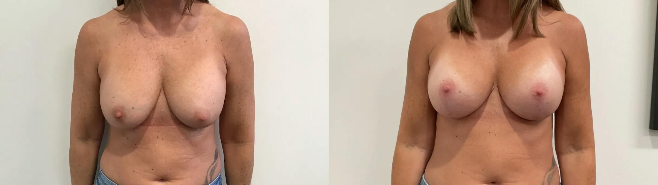 Breast Augmentation Revision Before & After Gallery - Patient 137972 - Image 1