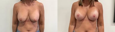 Breast Augmentation Revision Before & After Gallery - Patient 137972 - Image 1