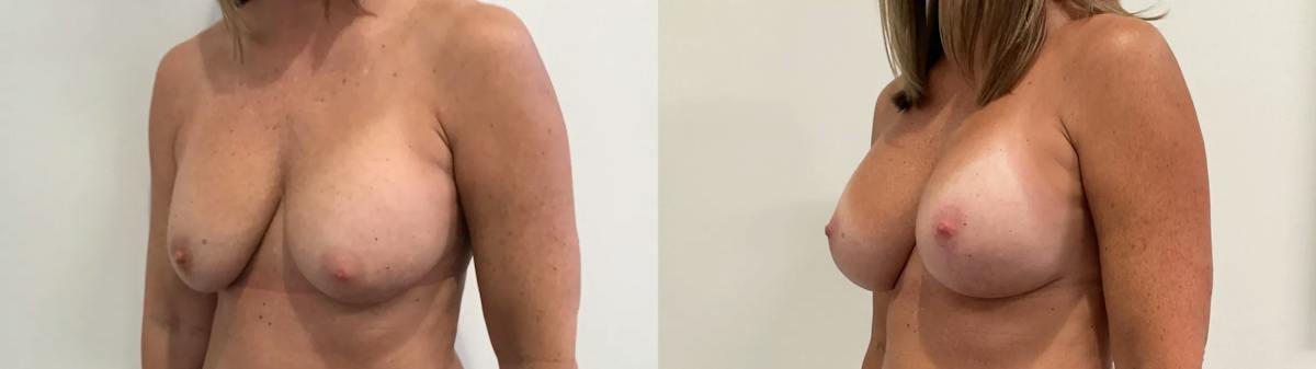 Breast Augmentation Revision Before & After Gallery - Patient 137972 - Image 2