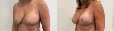 Breast Augmentation Revision Before & After Gallery - Patient 137972 - Image 2