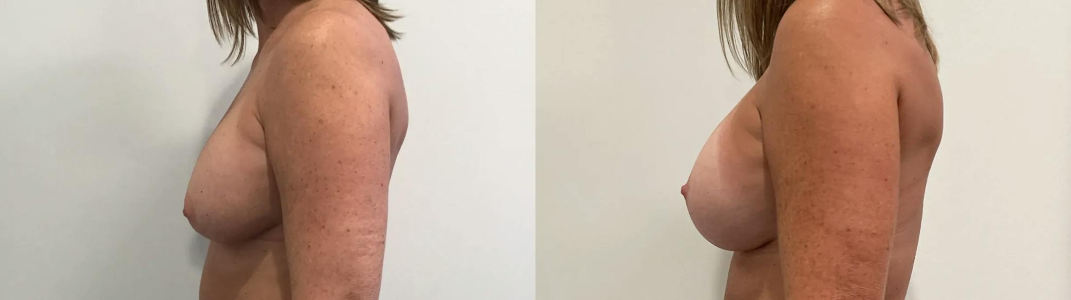 Breast Augmentation Revision Before & After Gallery - Patient 137972 - Image 3