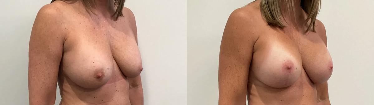 Breast Augmentation Revision Before & After Gallery - Patient 137972 - Image 4
