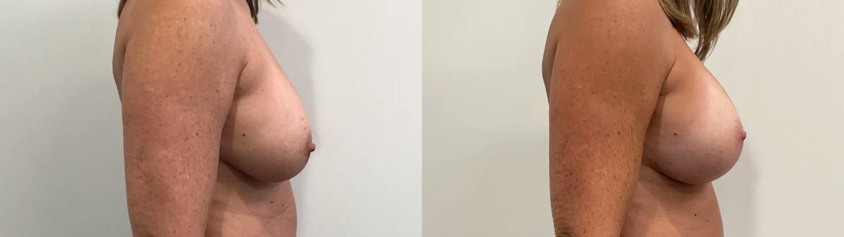 Breast Augmentation Revision Before & After Gallery - Patient 137972 - Image 5