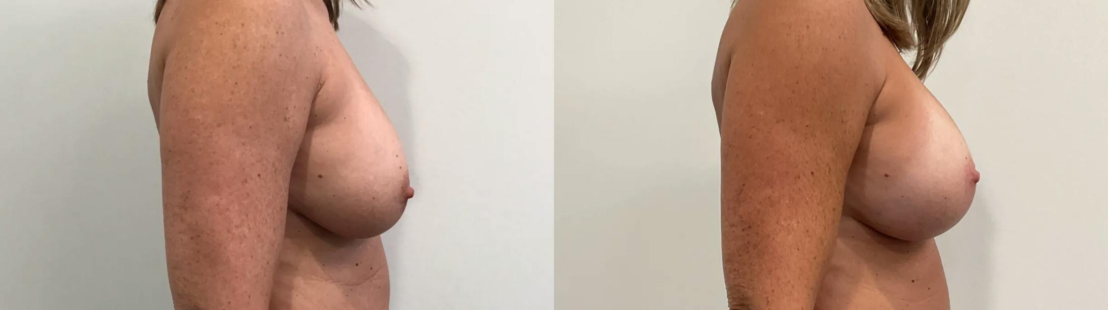 Breast Augmentation Revision Before & After Gallery - Patient 137972 - Image 5