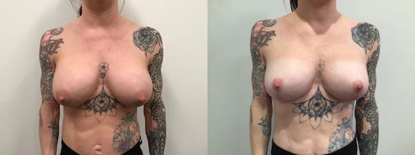 Breast Augmentation Revision Before & After Gallery - Patient 319724 - Image 1