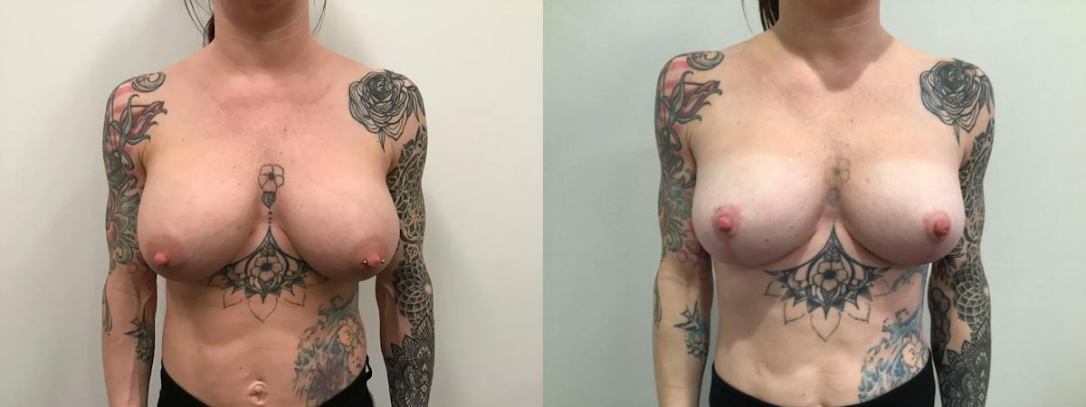 Breast Augmentation Revision Before & After Gallery - Patient 319724 - Image 1