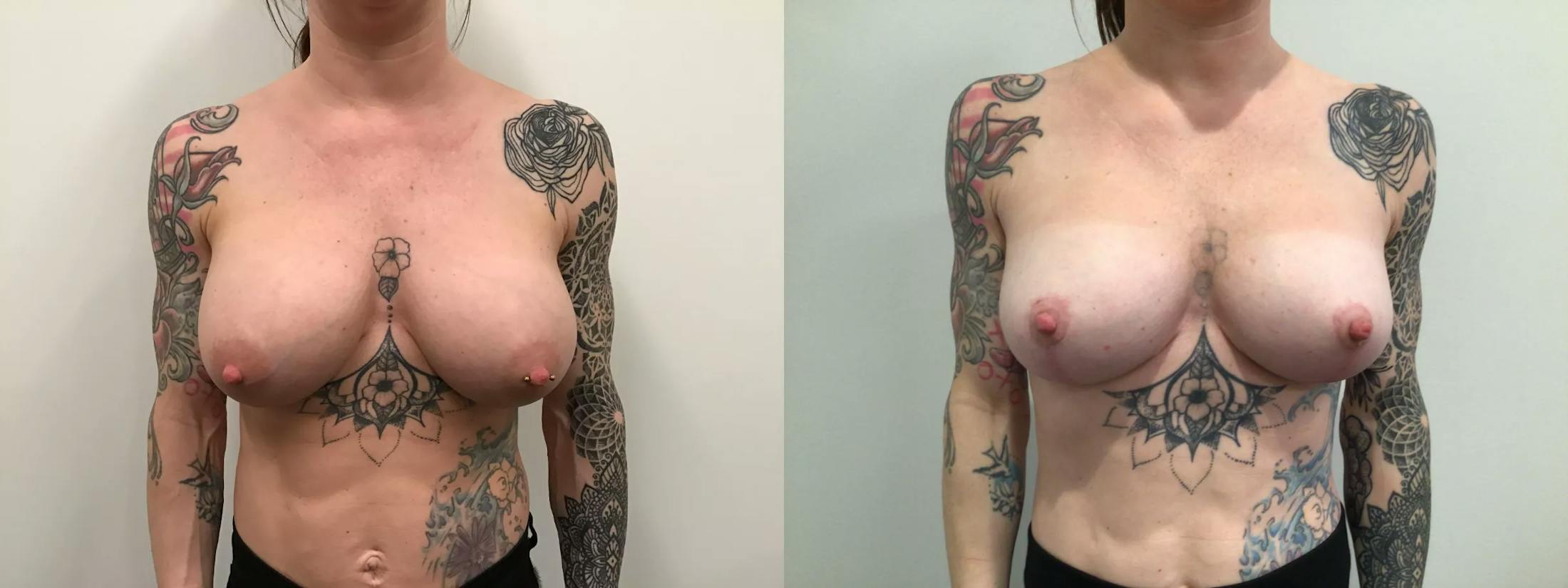 Breast Augmentation Revision Before & After Gallery - Patient 319724 - Image 1