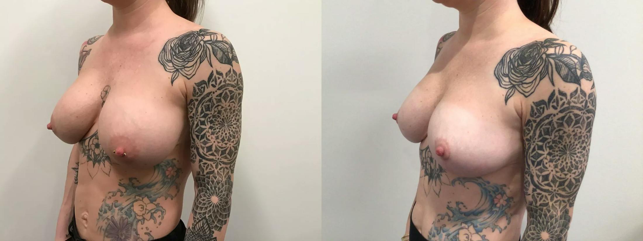 Breast Augmentation Revision Before & After Gallery - Patient 319724 - Image 2