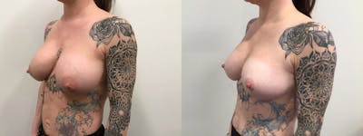 Breast Augmentation Revision Before & After Gallery - Patient 319724 - Image 2