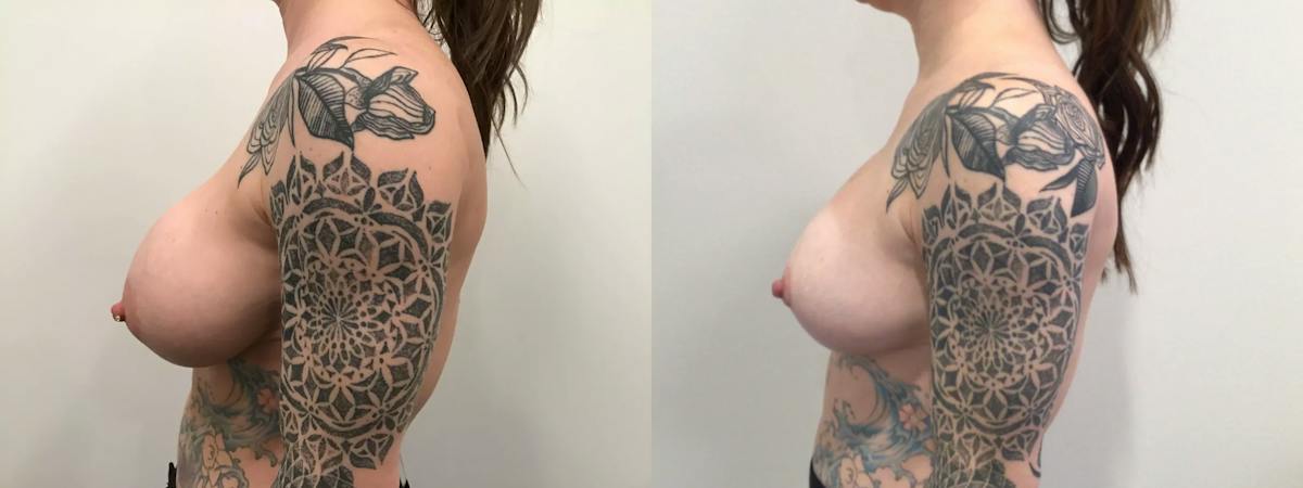Breast Augmentation Revision Before & After Gallery - Patient 319724 - Image 3