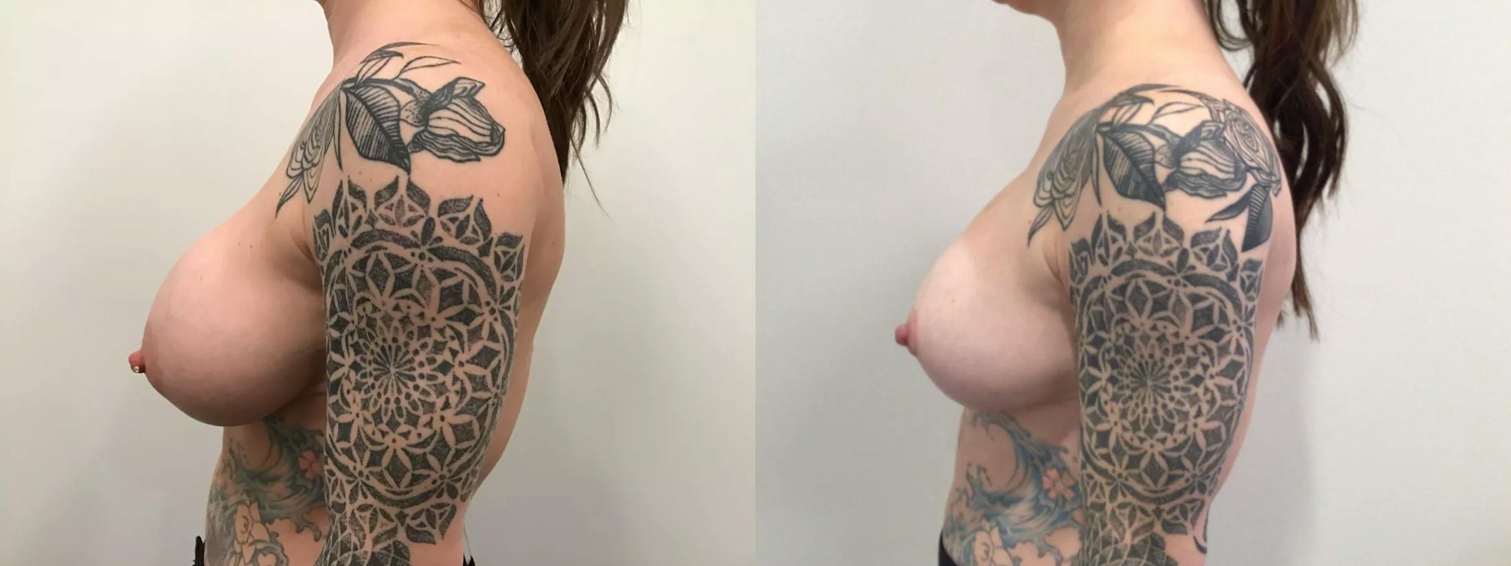 Breast Augmentation Revision Before & After Gallery - Patient 319724 - Image 3