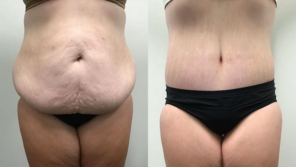 Body Contouring After Weight Loss Before & After Gallery - Patient 139571 - Image 1