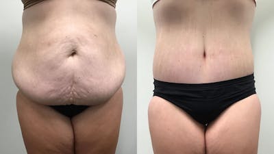 Body Contouring After Weight Loss Before & After Gallery - Patient 139571 - Image 1