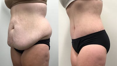 Body Contouring After Weight Loss Before & After Gallery - Patient 139571 - Image 2