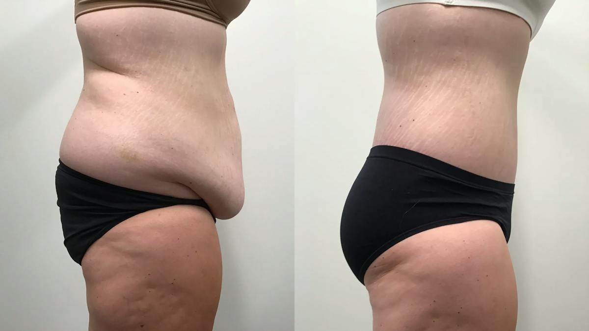 Body Contouring After Weight Loss Before & After Gallery - Patient 139571 - Image 3
