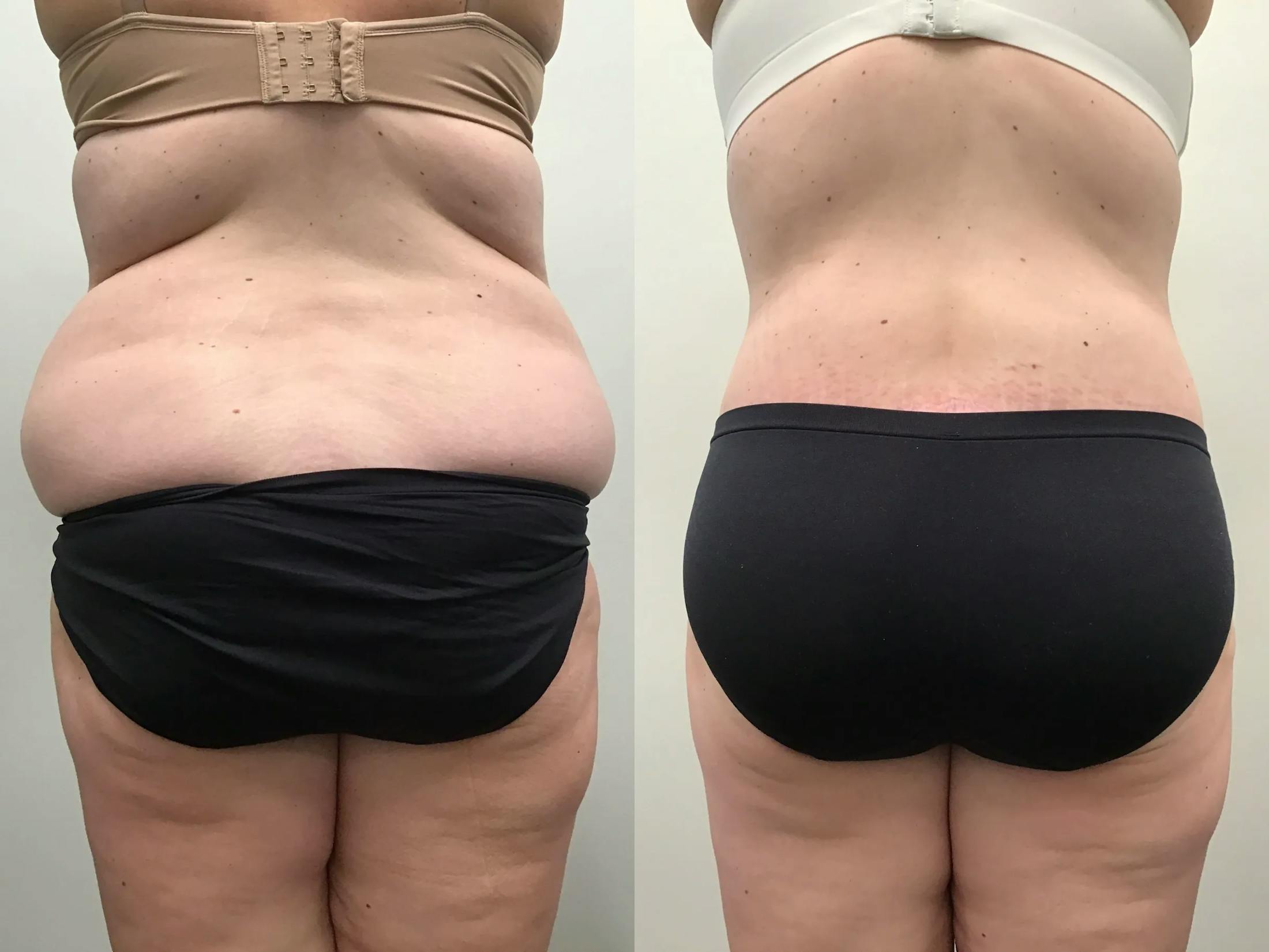 Body Contouring After Weight Loss Before & After Gallery - Patient 139571 - Image 4