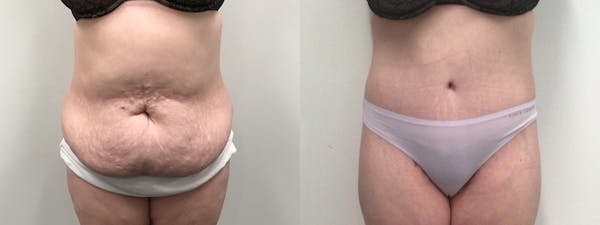 Body Contouring After Weight Loss Before & After Gallery - Patient 277992 - Image 1