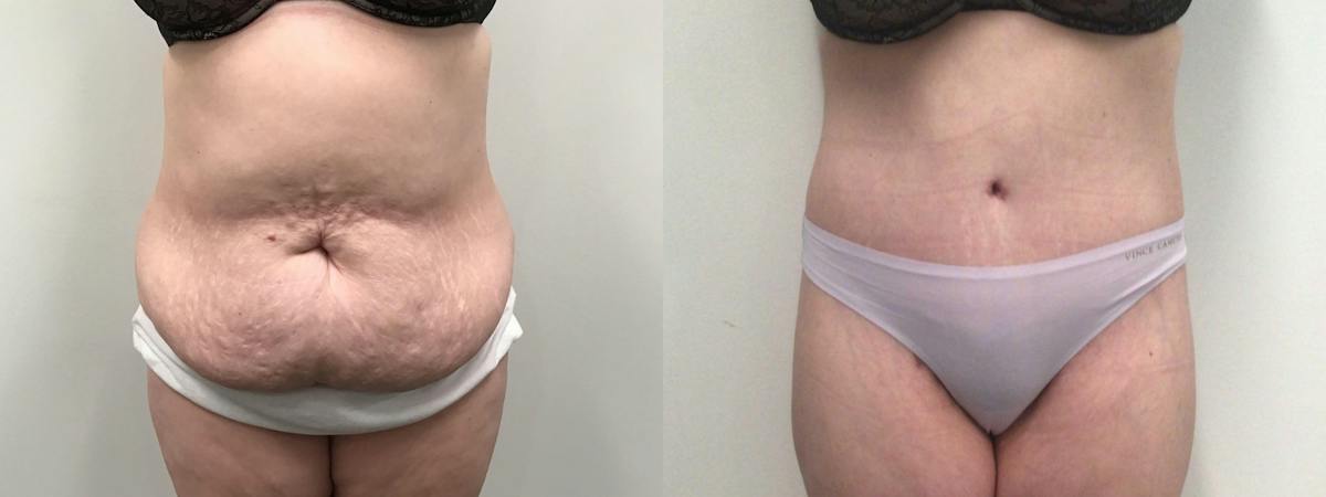 Body Contouring After Weight Loss Before & After Gallery - Patient 277992 - Image 1