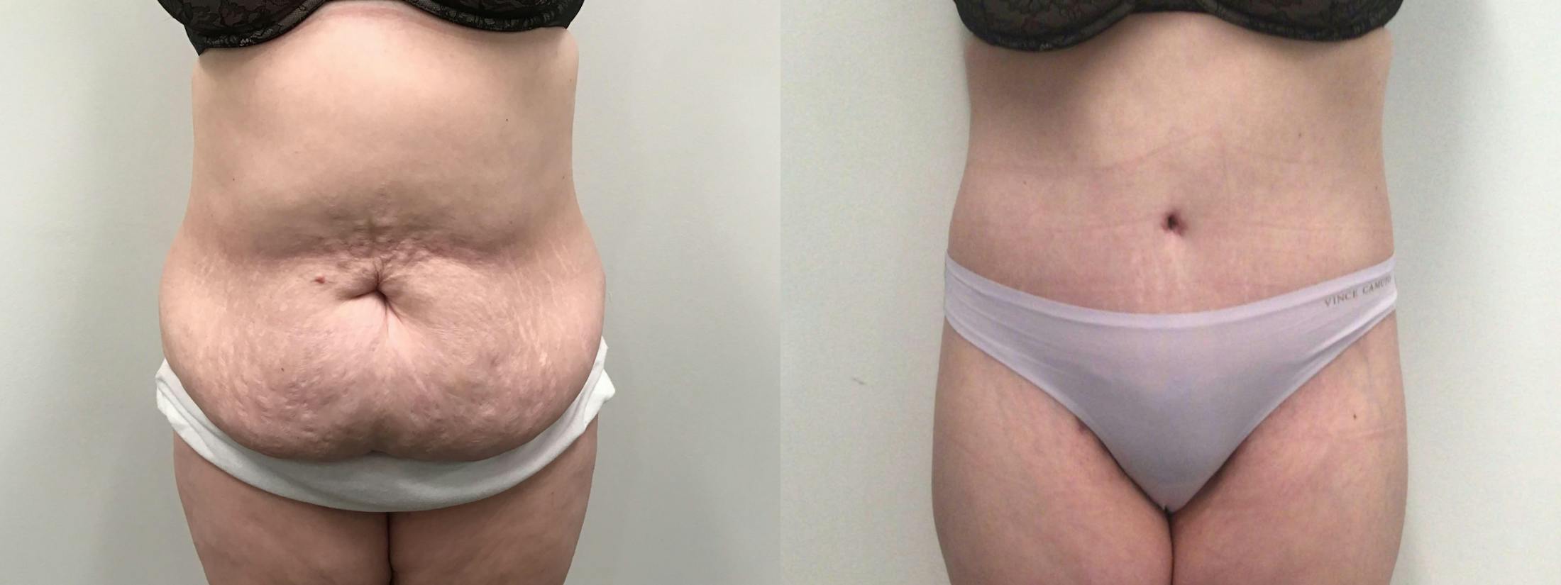 Body Contouring After Weight Loss Before & After Gallery - Patient 277992 - Image 1