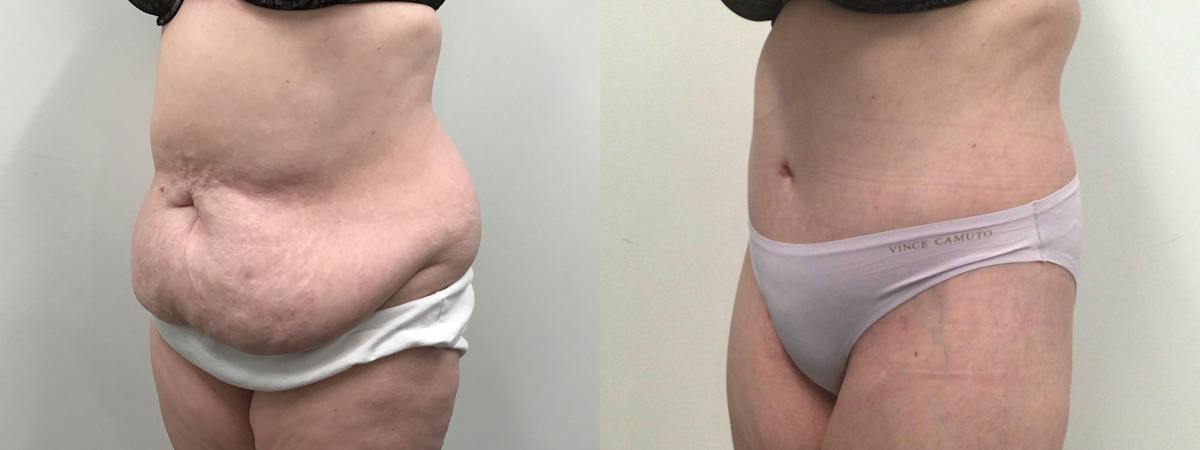 Body Contouring After Weight Loss Before & After Gallery - Patient 277992 - Image 2