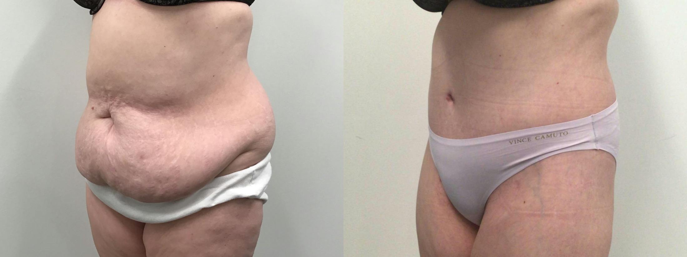 Body Contouring After Weight Loss Before & After Gallery - Patient 277992 - Image 2