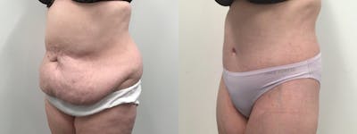 Body Contouring After Weight Loss Before & After Gallery - Patient 277992 - Image 2