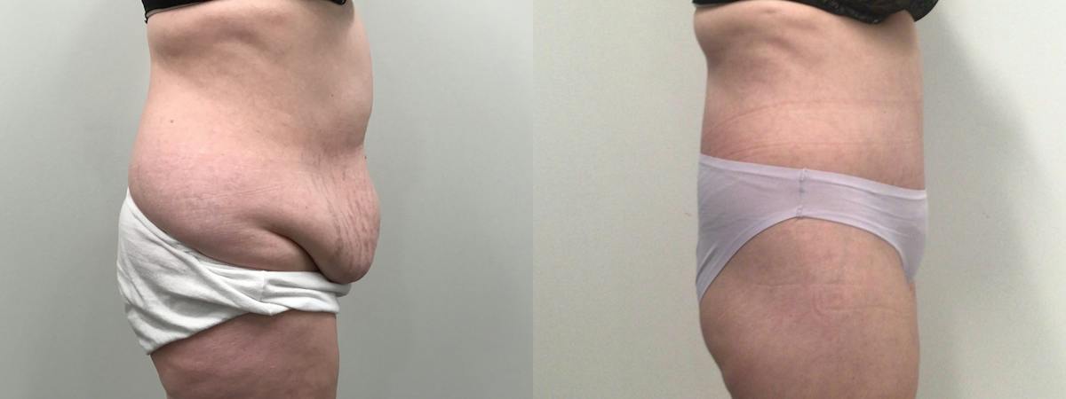 Body Contouring After Weight Loss Before & After Gallery - Patient 277992 - Image 3