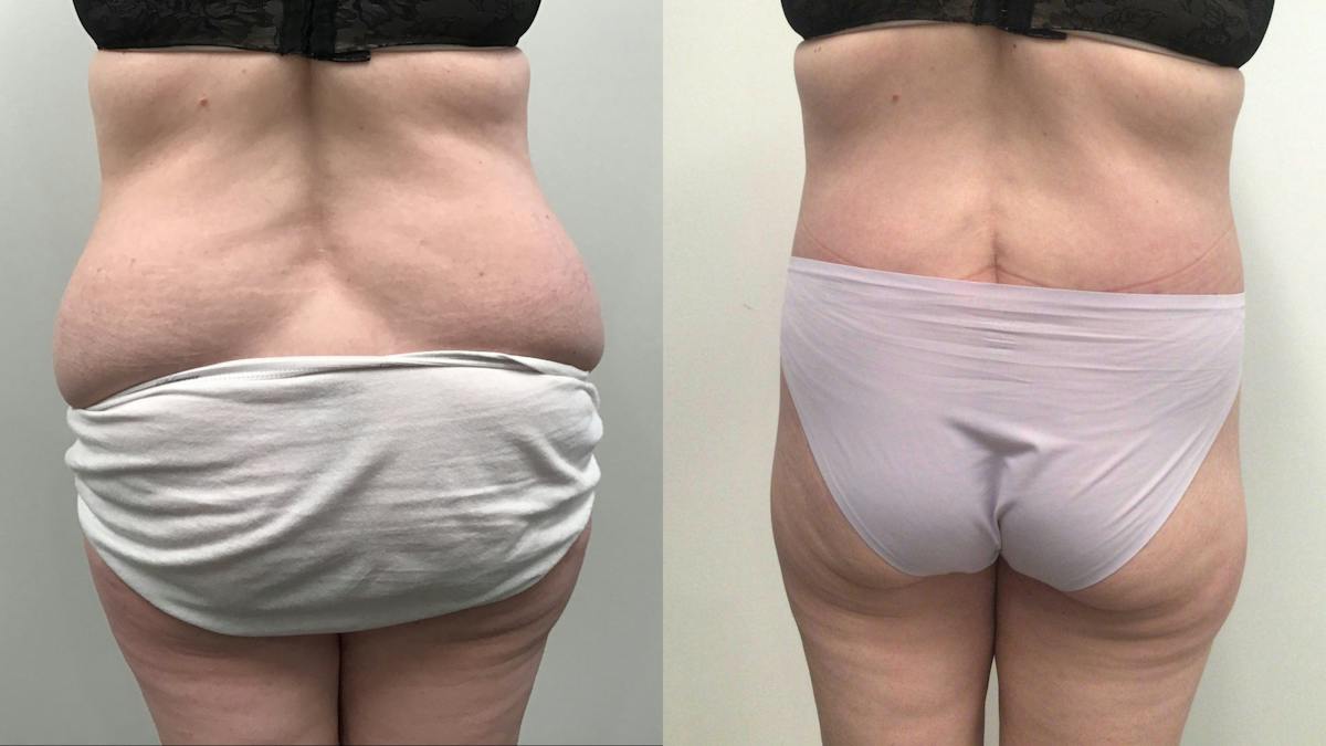 Body Contouring After Weight Loss Before & After Gallery - Patient 277992 - Image 4