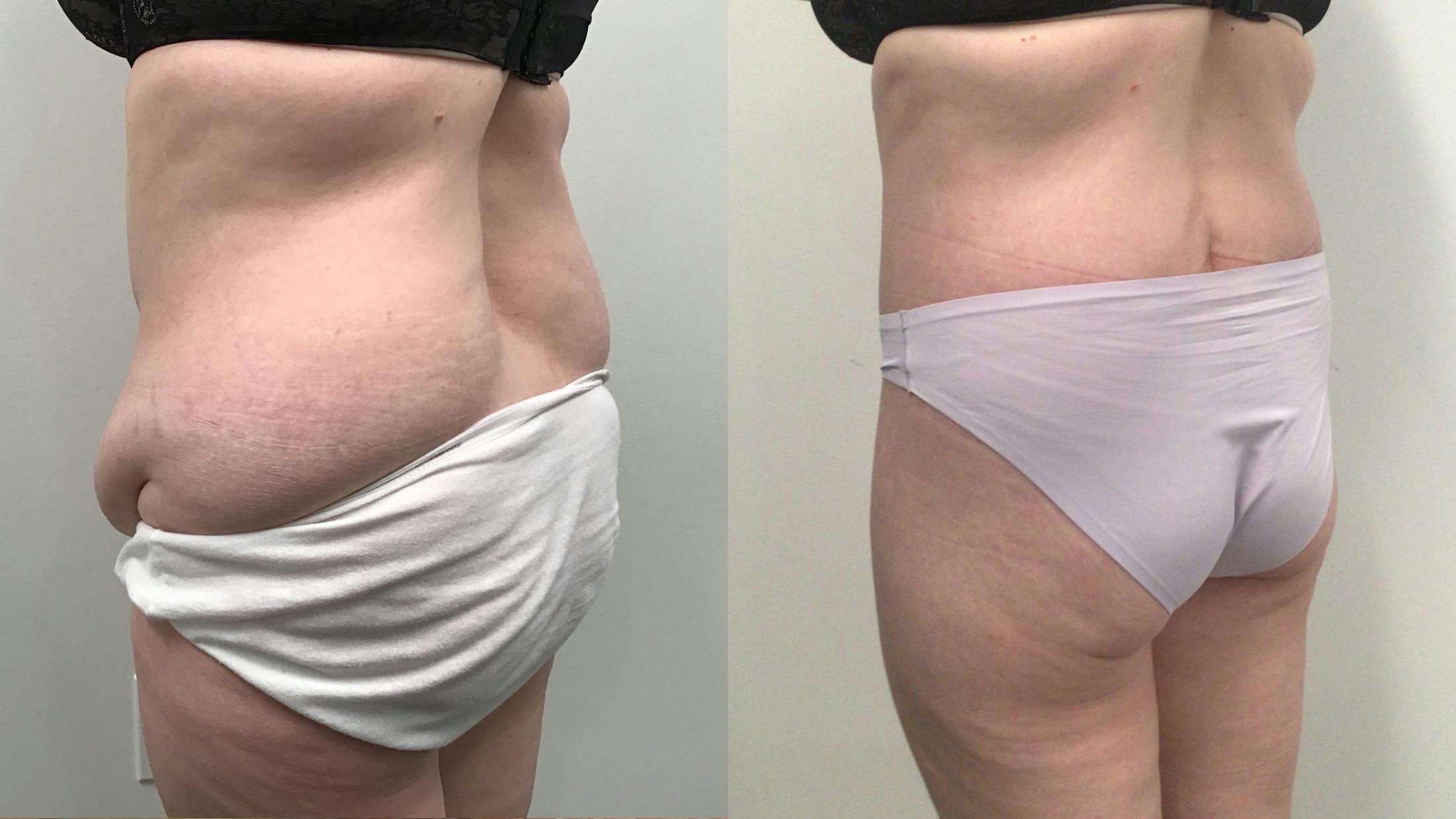 Body Contouring After Weight Loss Before & After Gallery - Patient 277992 - Image 5