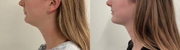Liposuction Before & After Gallery - Patient 153951 - Image 1