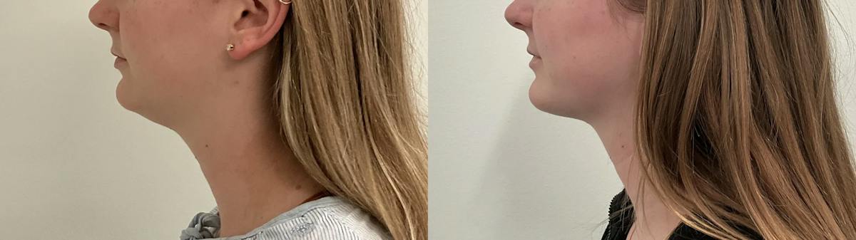Liposuction Before & After Gallery - Patient 153951 - Image 1
