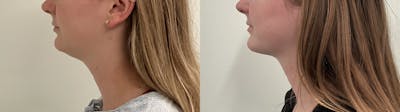 Liposuction Before & After Gallery - Patient 153951 - Image 1