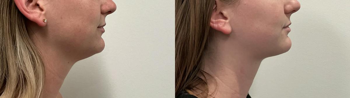 Liposuction Before & After Gallery - Patient 153951 - Image 2