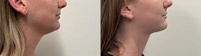 Liposuction Before & After Gallery - Patient 153951 - Image 2