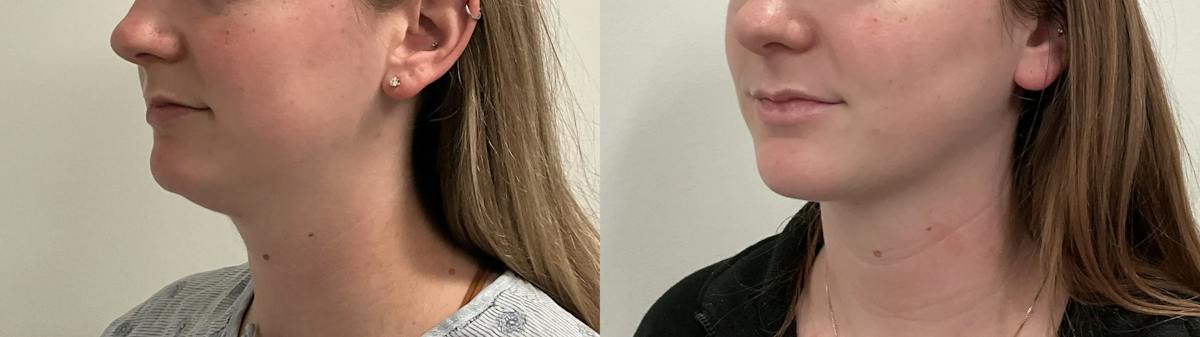 Liposuction Before & After Gallery - Patient 153951 - Image 3