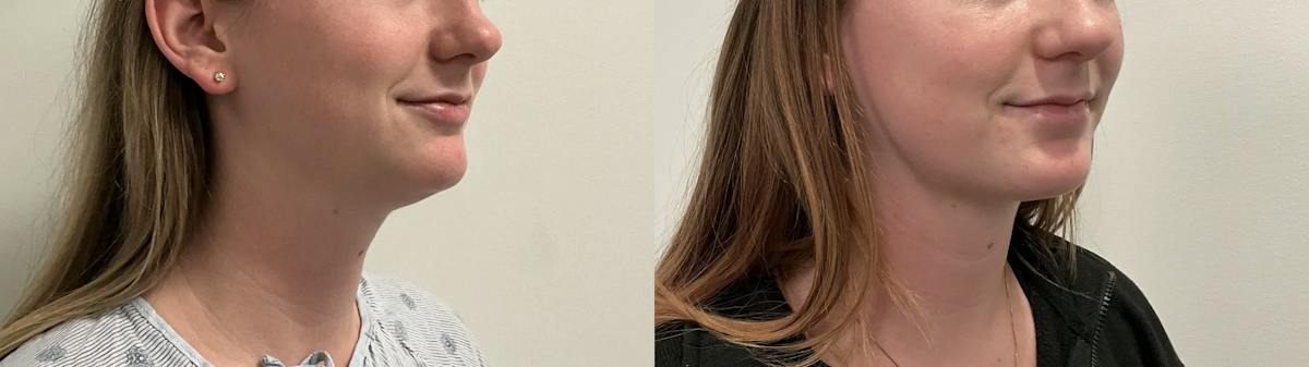 Liposuction Before & After Gallery - Patient 153951 - Image 4