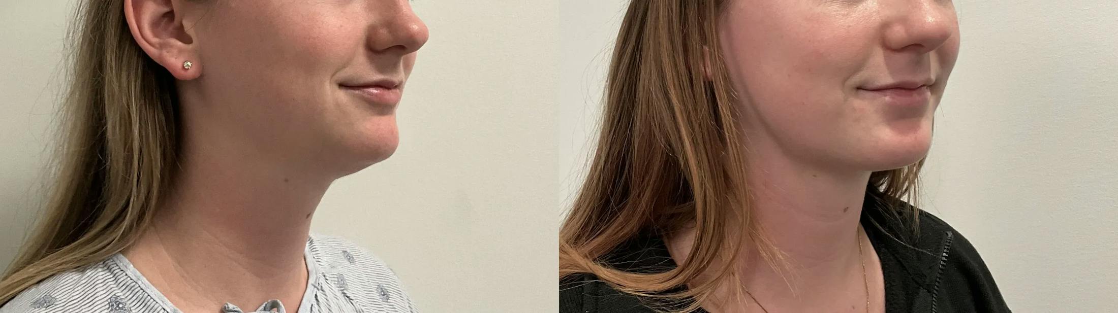 Liposuction Before & After Gallery - Patient 153951 - Image 4