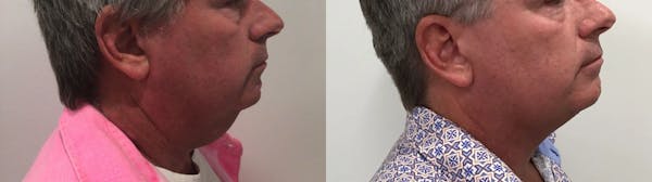 Liposuction Before & After Gallery - Patient 258300 - Image 1