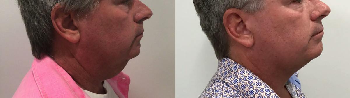 Liposuction Before & After Gallery - Patient 258300 - Image 1