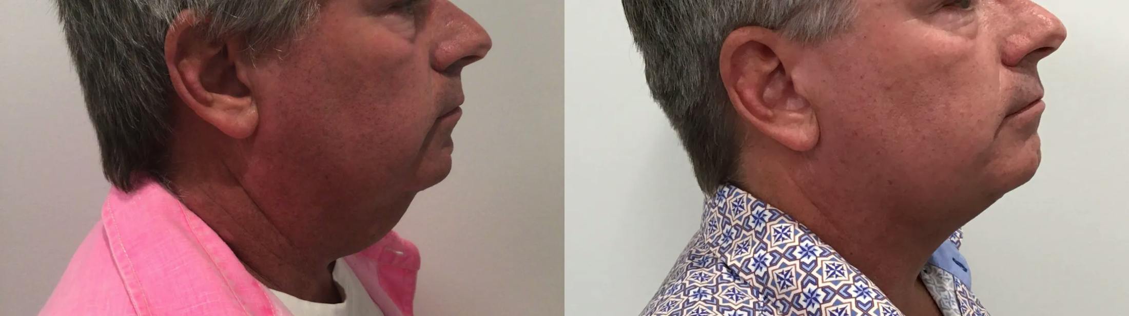 Liposuction Before & After Gallery - Patient 258300 - Image 1