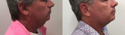 Liposuction Before & After Gallery - Patient 258300 - Image 1
