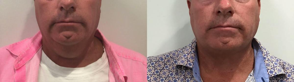 Liposuction Before & After Gallery - Patient 258300 - Image 2