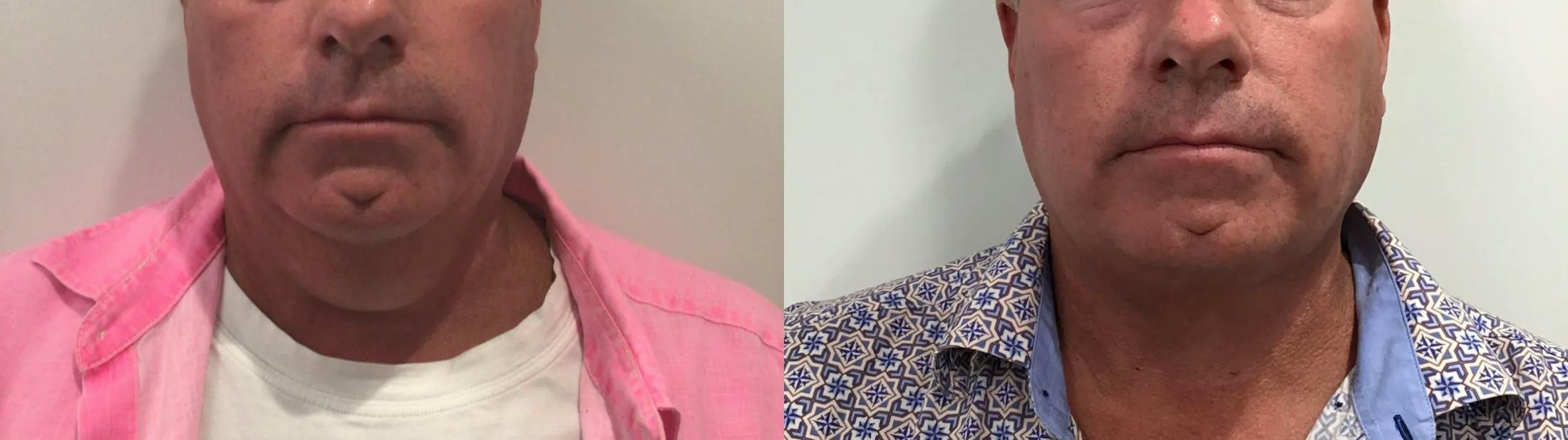 Liposuction Before & After Gallery - Patient 258300 - Image 2