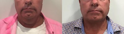 Liposuction Before & After Gallery - Patient 258300 - Image 2