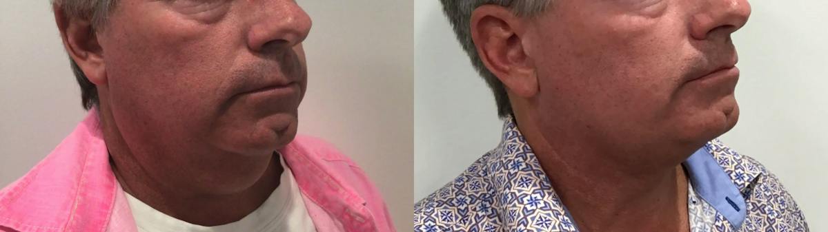 Liposuction Before & After Gallery - Patient 258300 - Image 3
