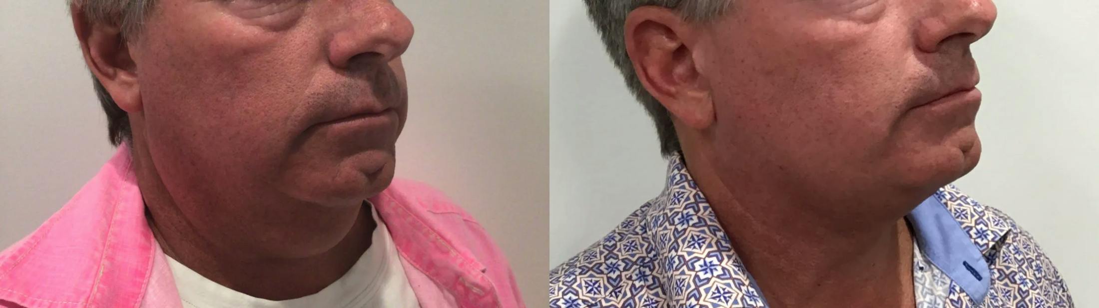 Liposuction Before & After Gallery - Patient 258300 - Image 3