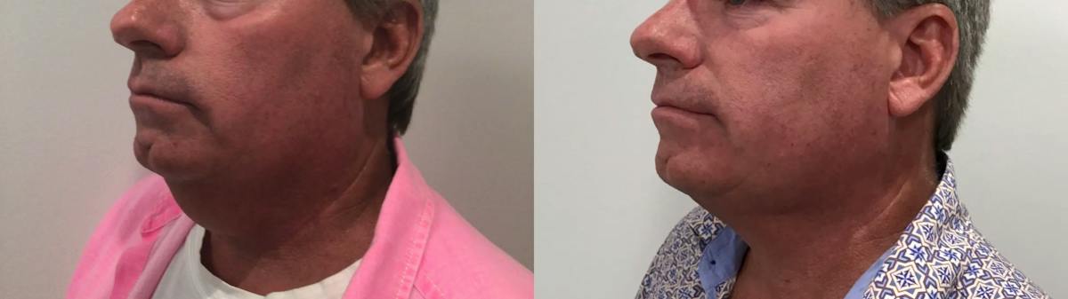 Liposuction Before & After Gallery - Patient 258300 - Image 4